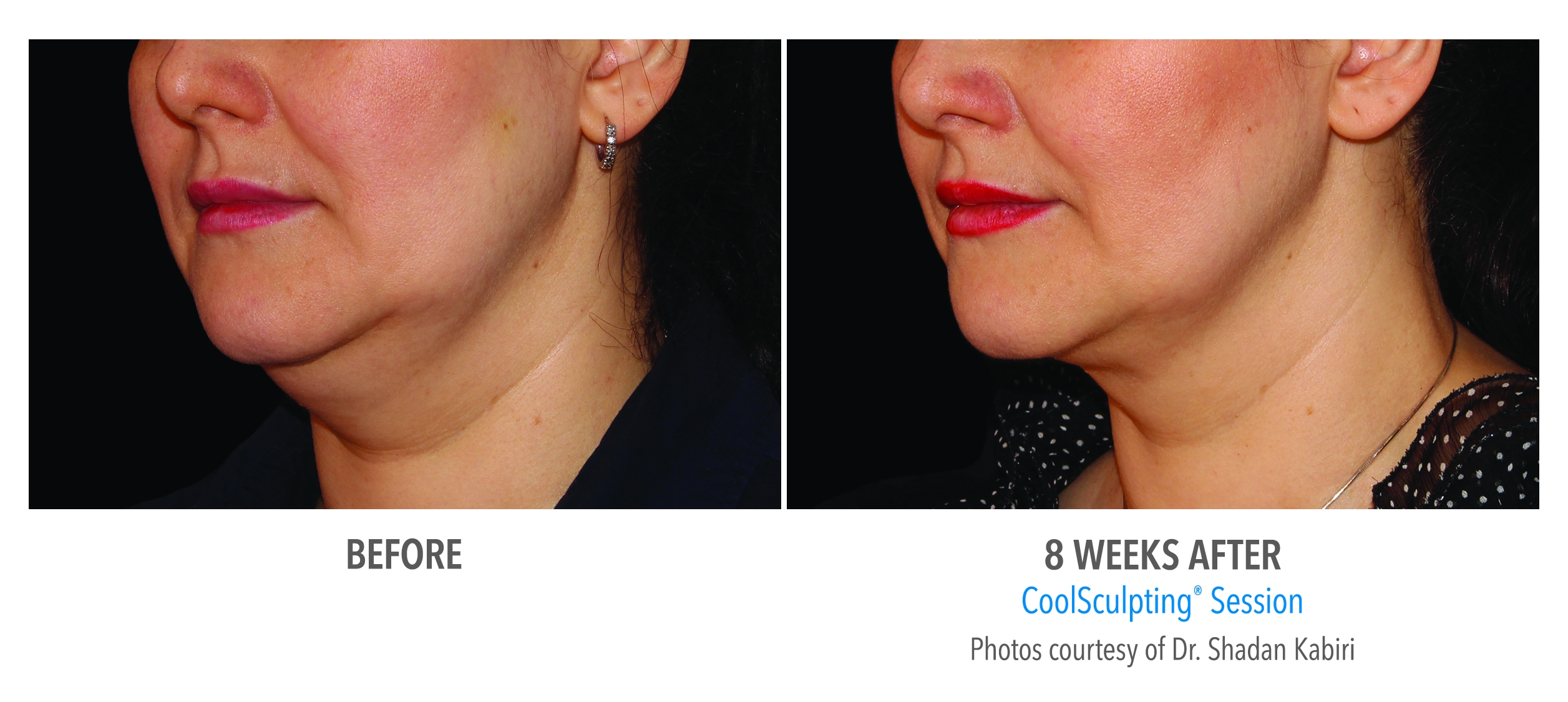 before after double chin coolsculpting