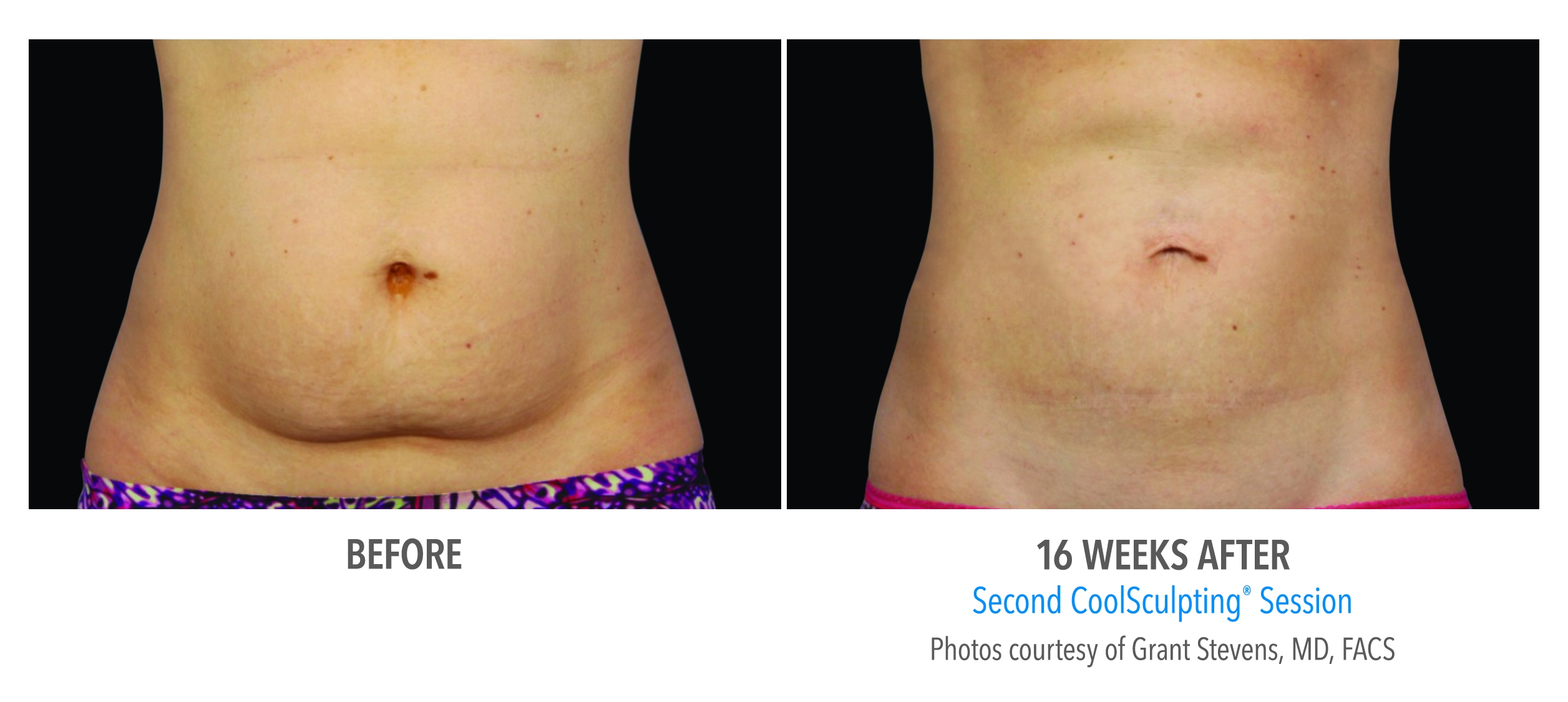 belly fat coolsculpting before after