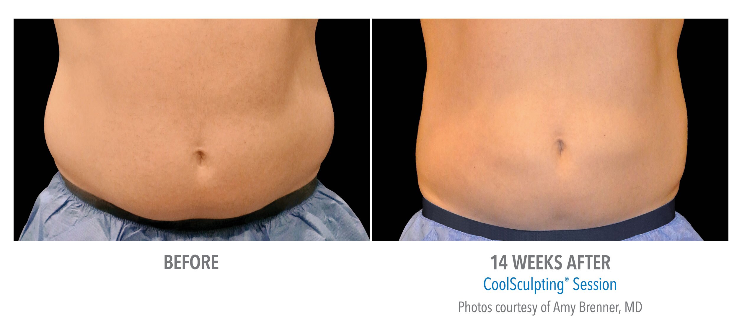 body contouring coolsculpting