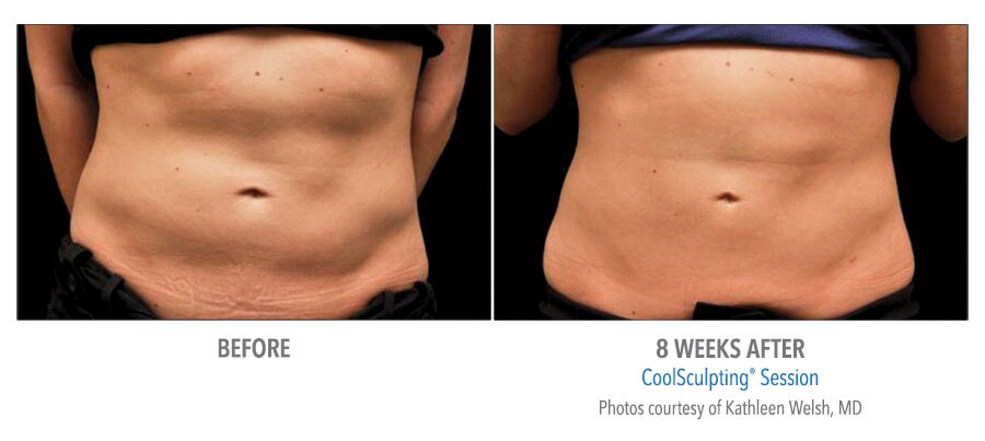 body contouring coolsculpting before after