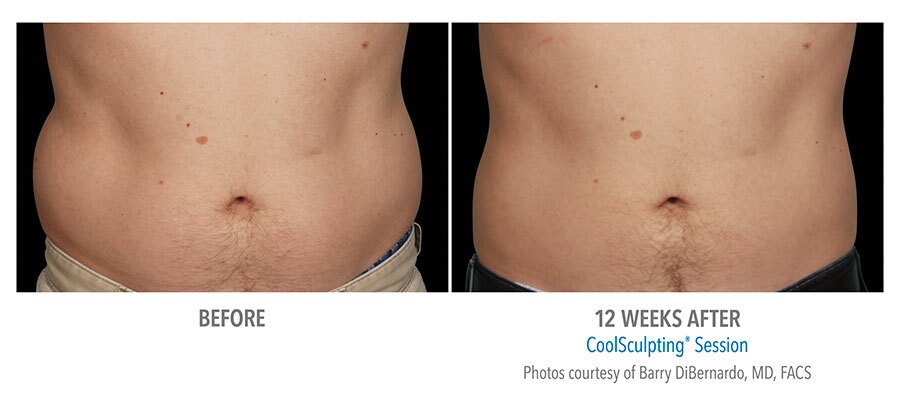 coolsculpting abdomen before after