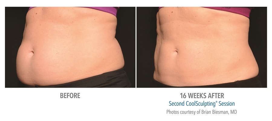 coolsculpting abs before after