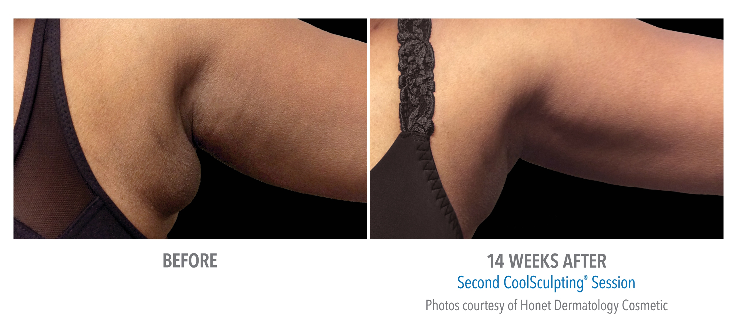 coolsculpting armpit fat reduction