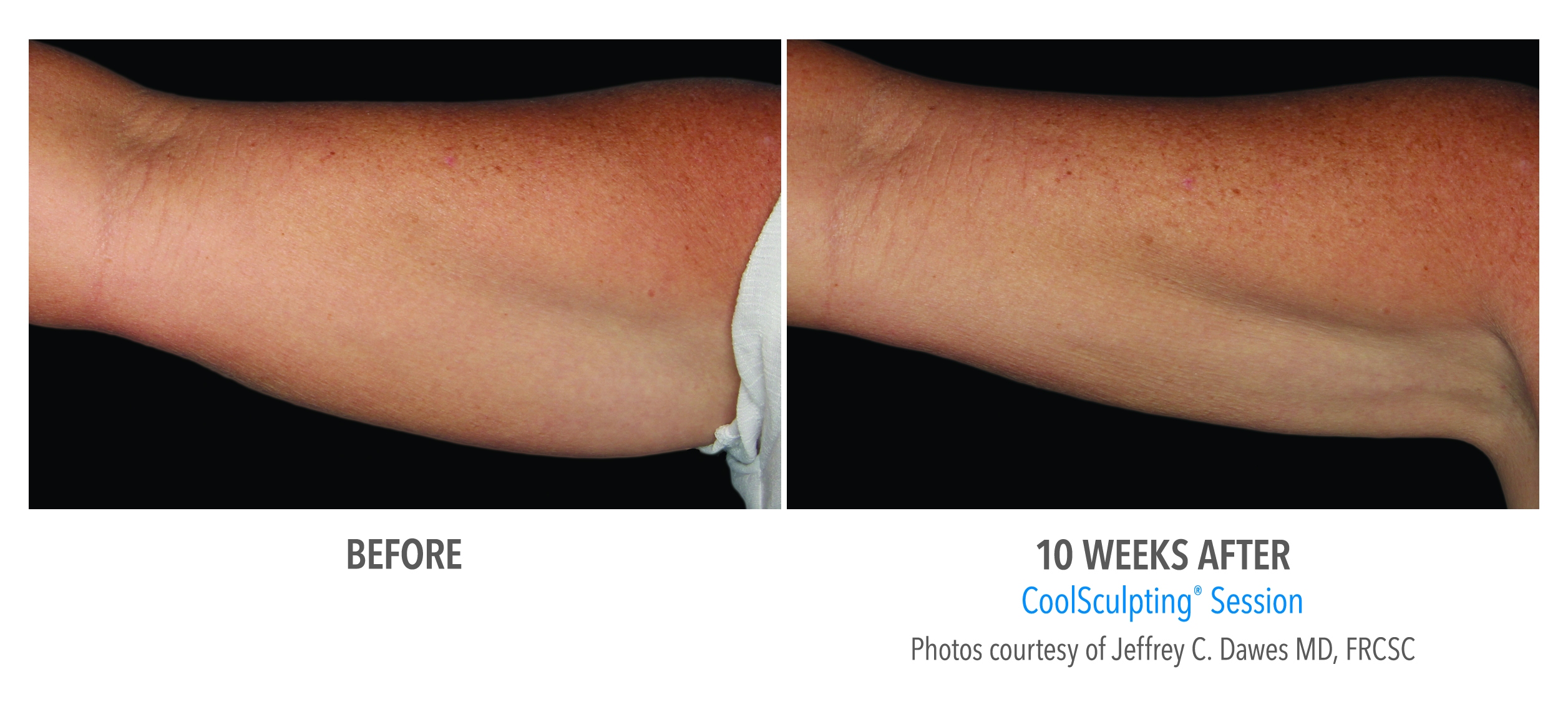 coolsculpting arms before after