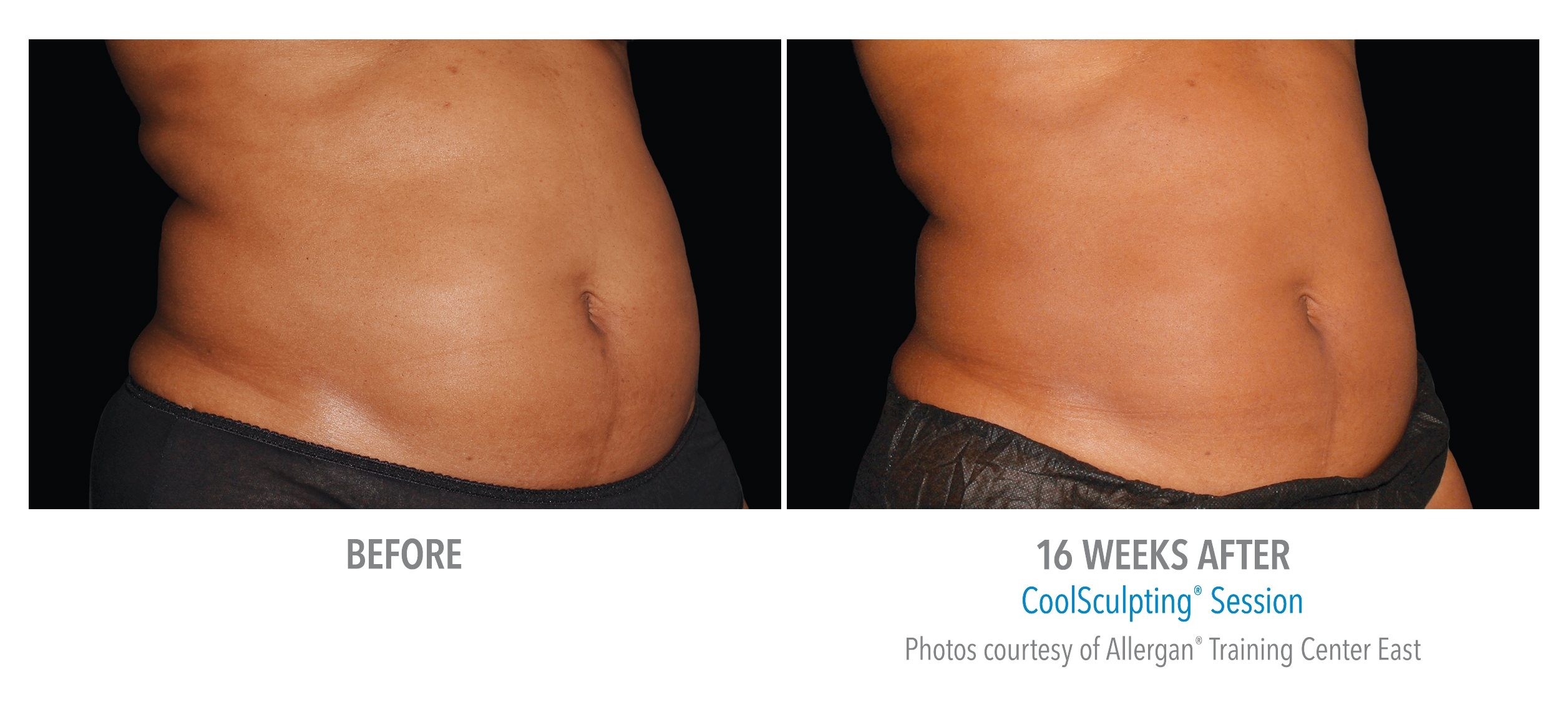 coolsculpting before and after