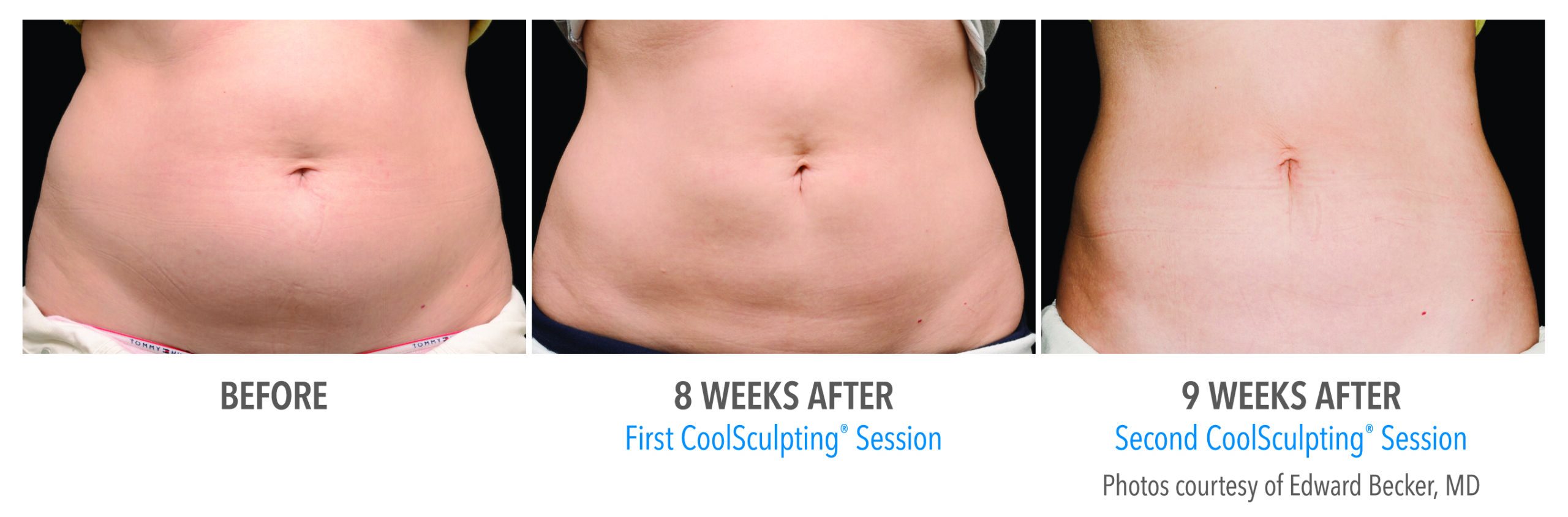 coolsculpting before during after