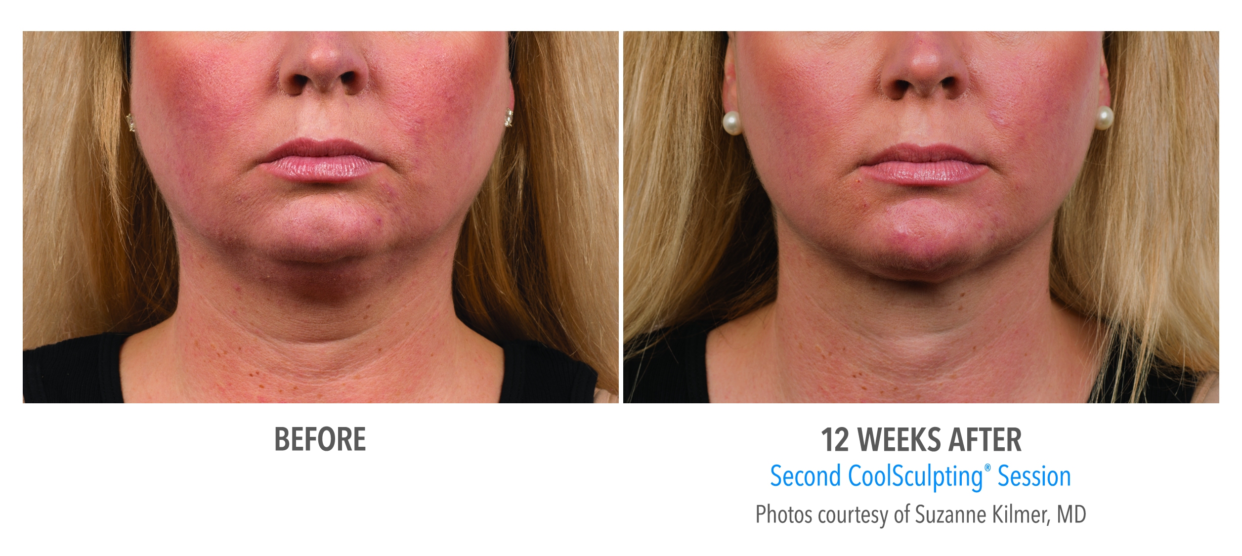 coolsculpting jaw before after