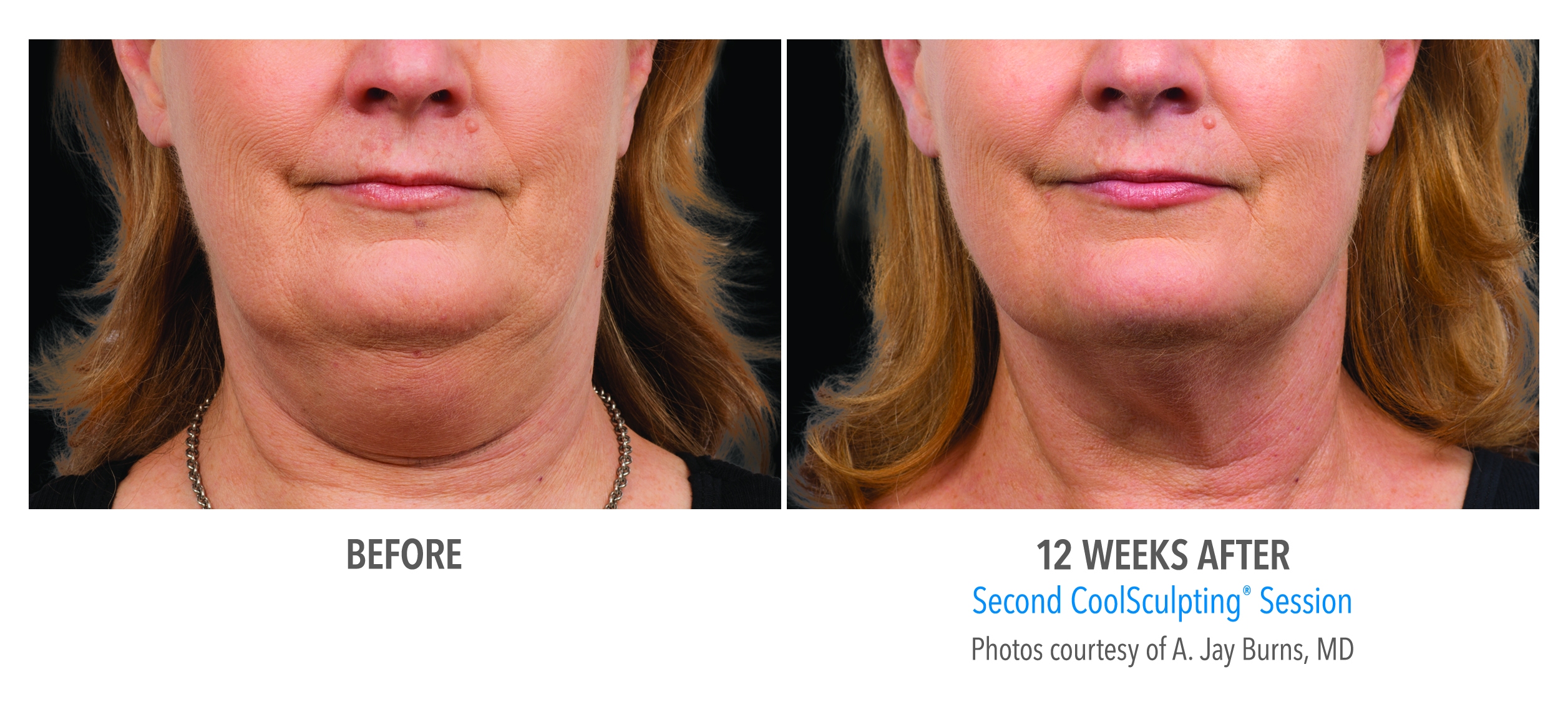 coolsculpting jawline before after