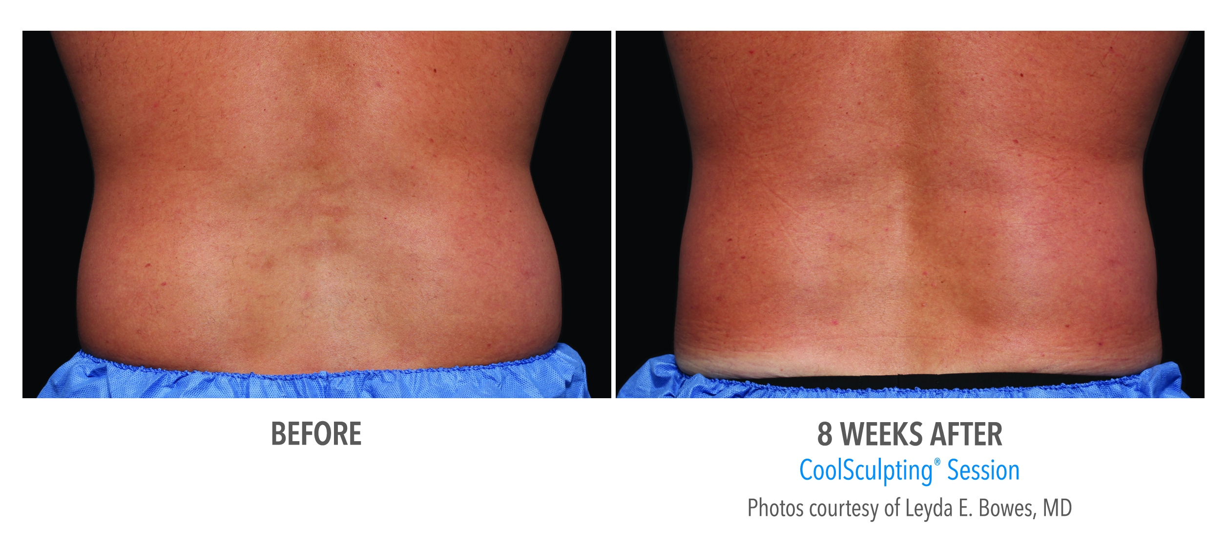coolsculpting love handles before after