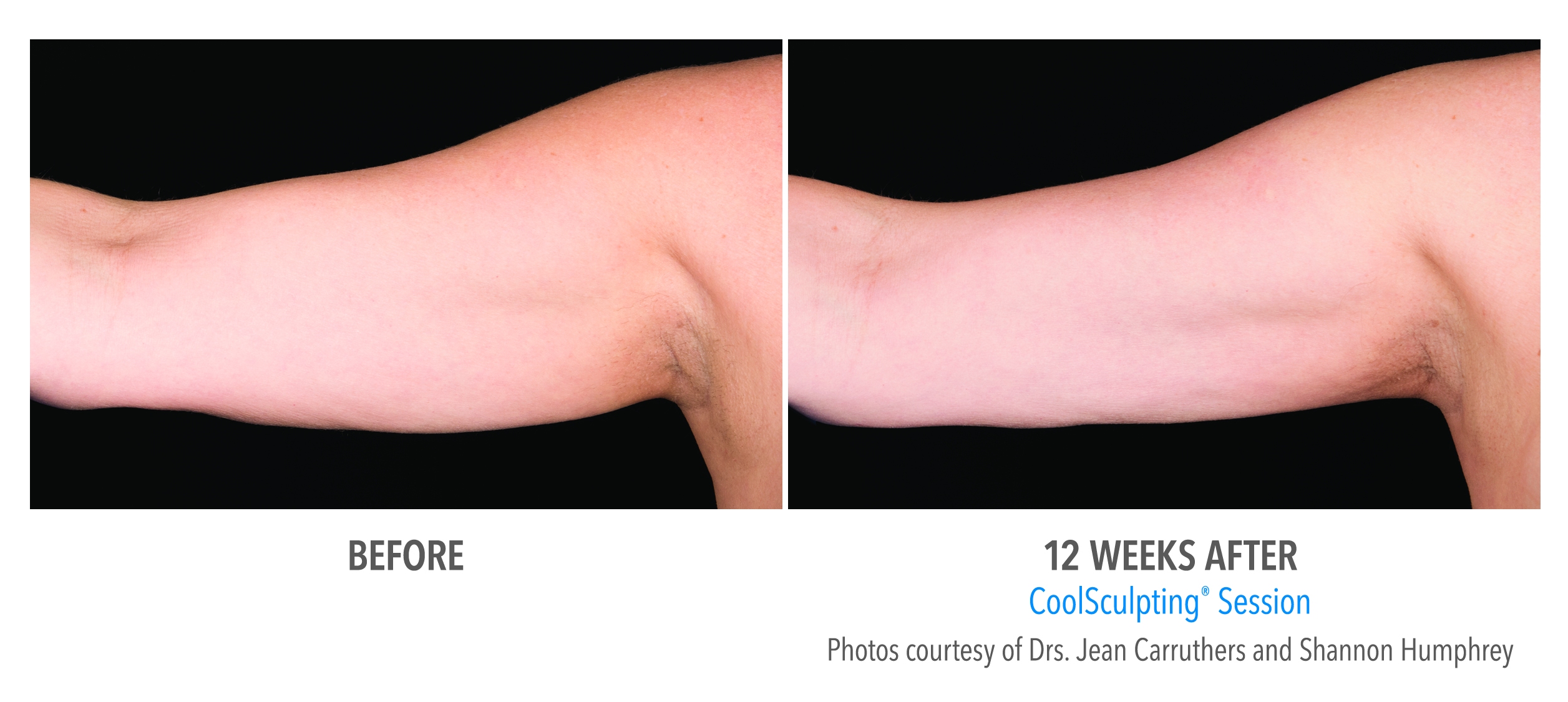 flabby arm correction before after