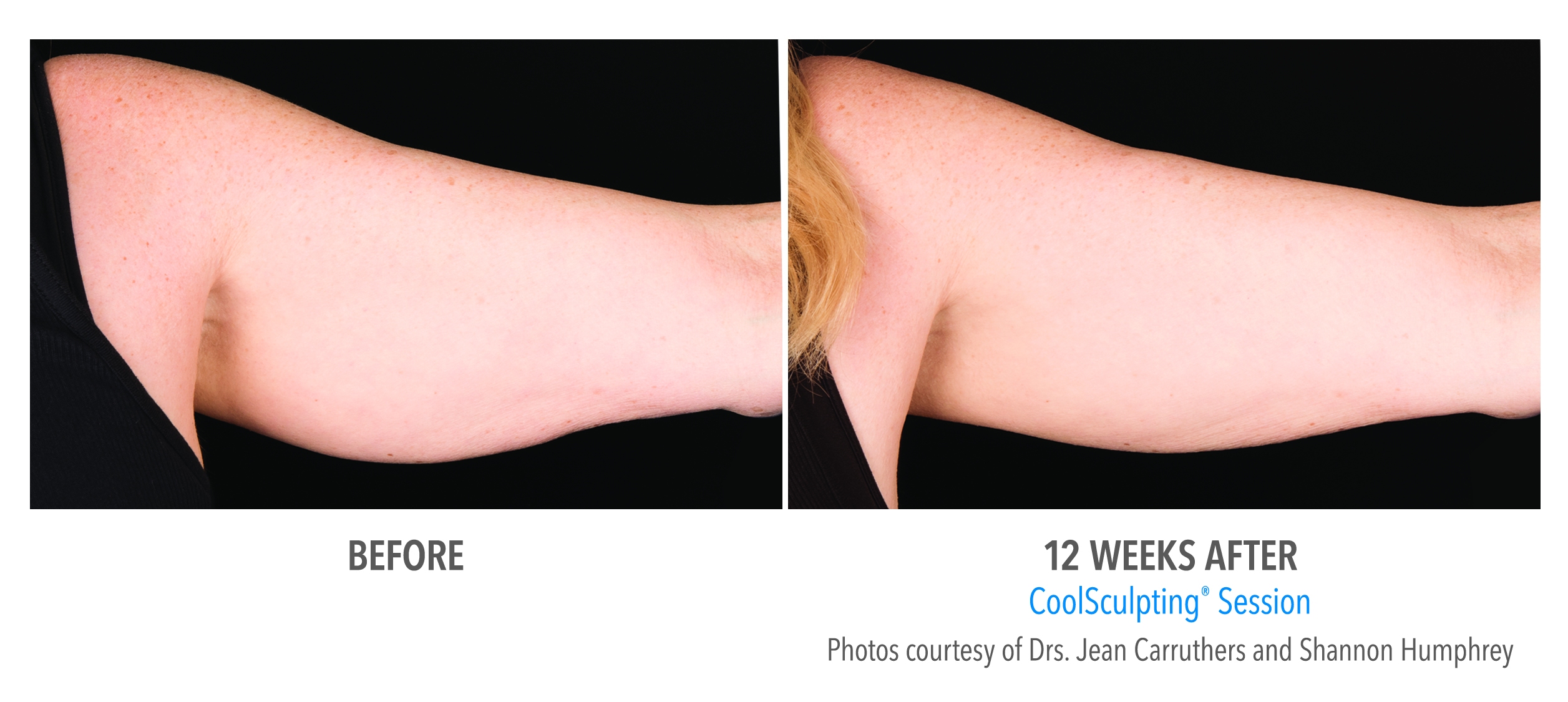 flabby arms coolsculpting before after