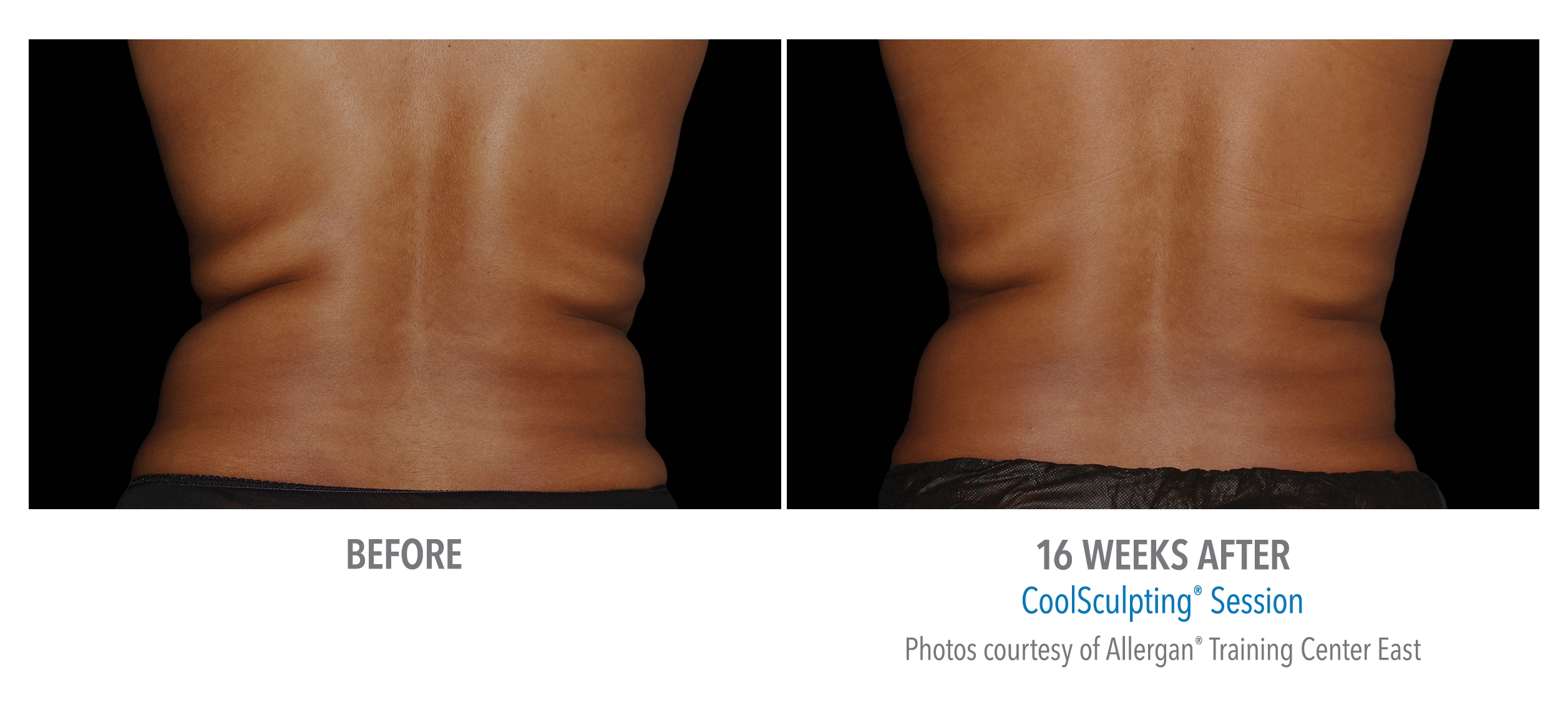 flanks coolsculpting before after