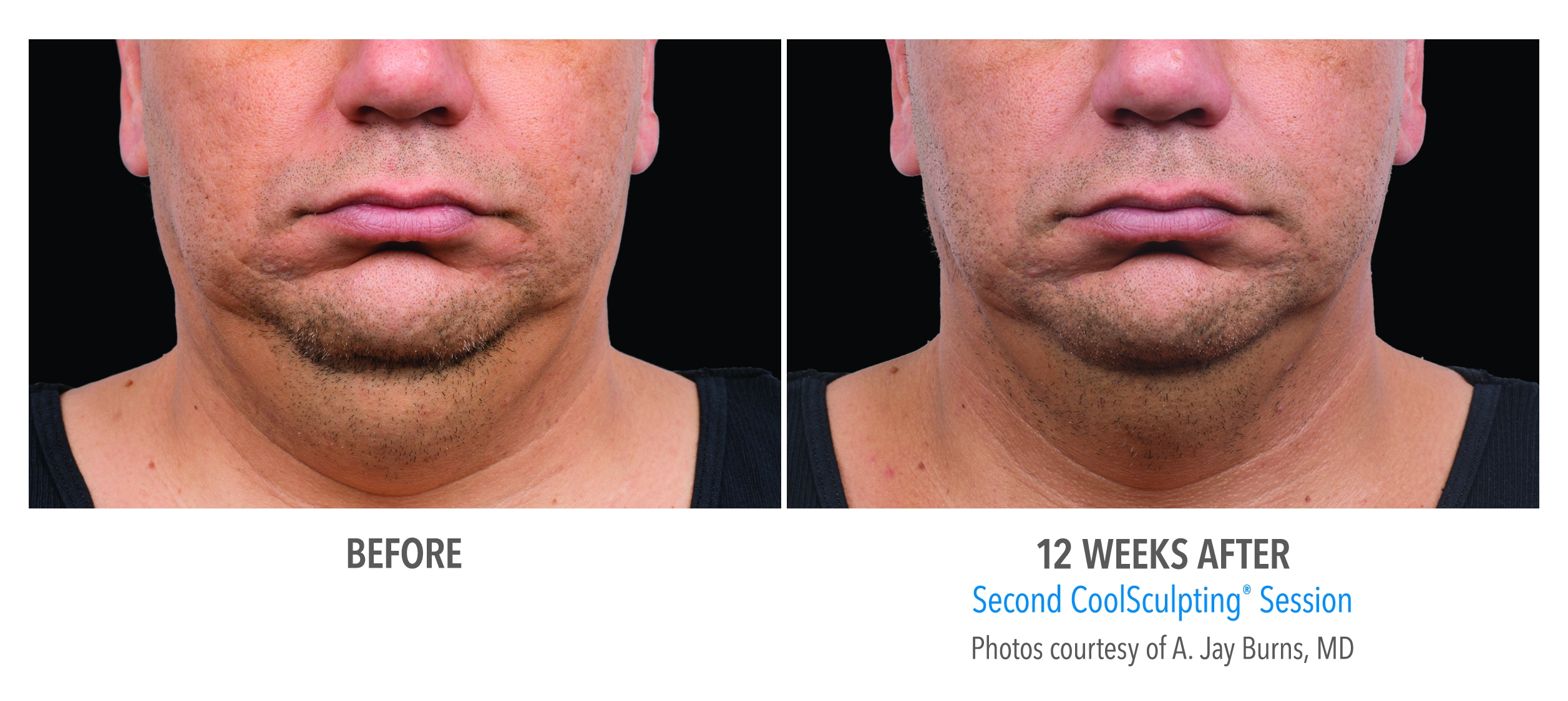 jawline coolsculpting before after