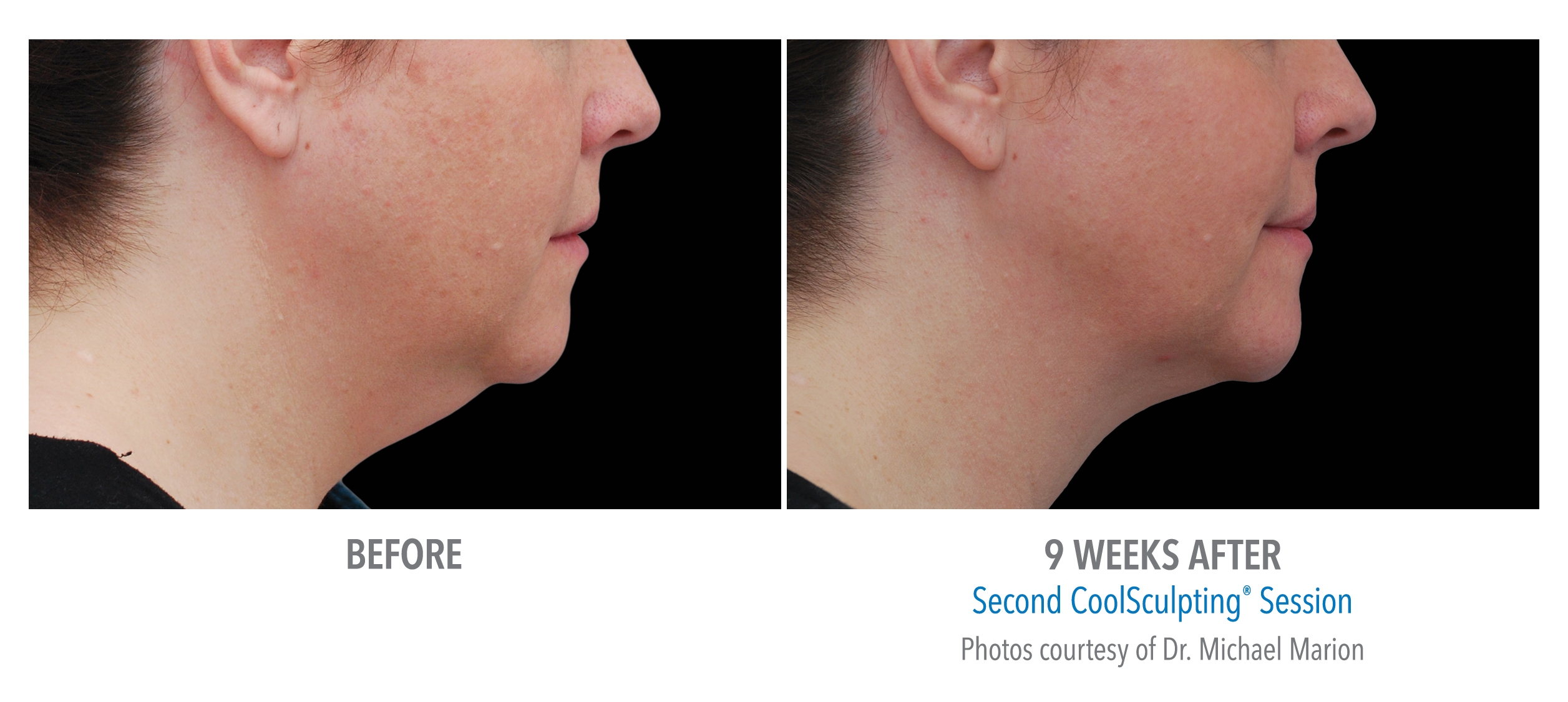 jawline definition coolsculpting before after