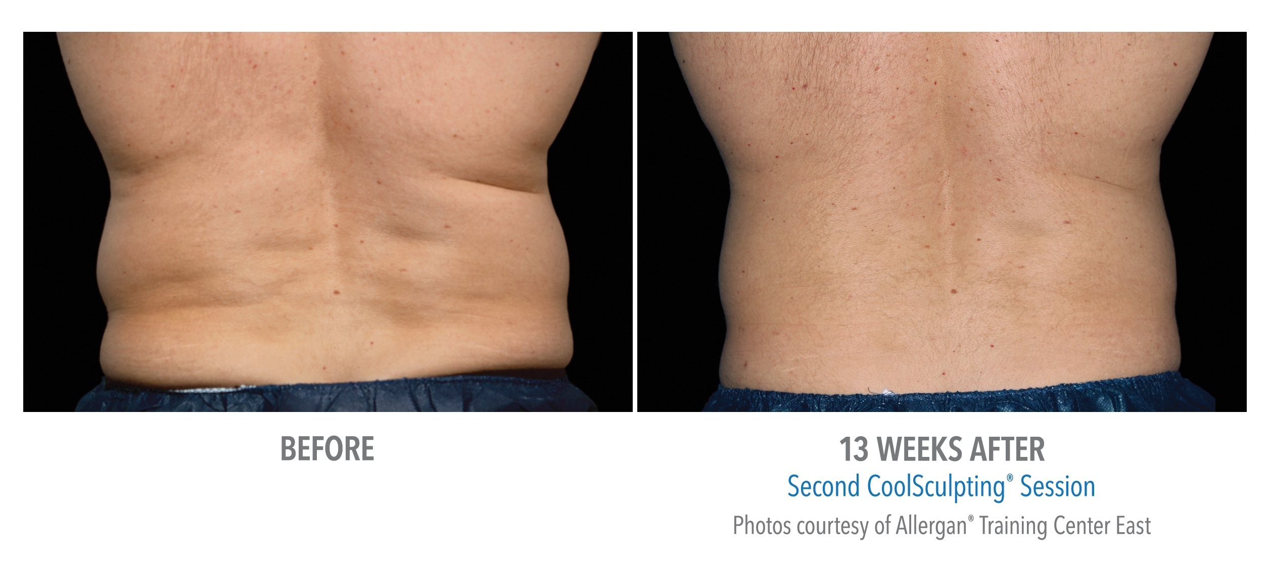 love handles before after