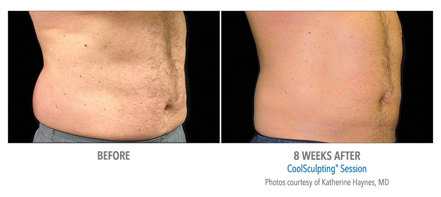 love handles before after coolsculpting