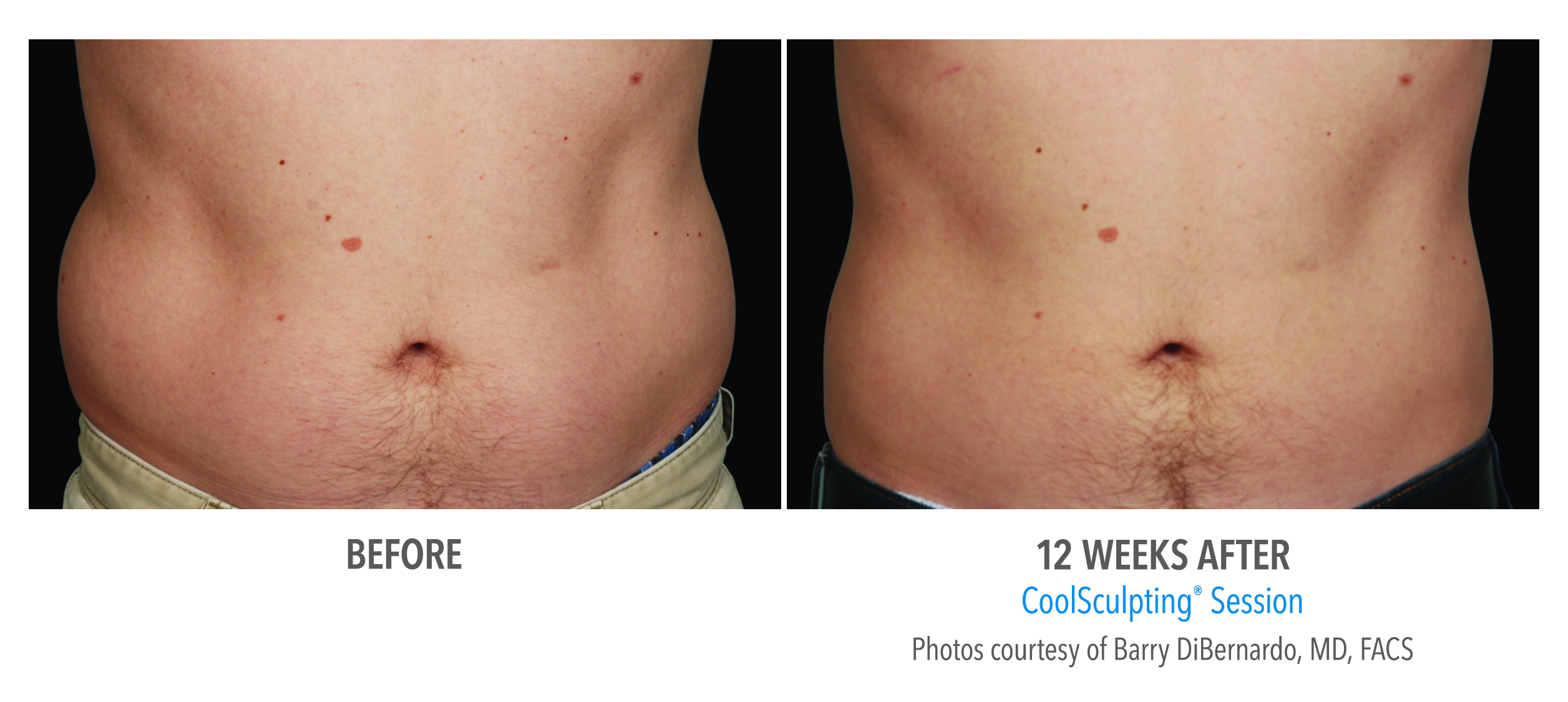 love handles reduction before after