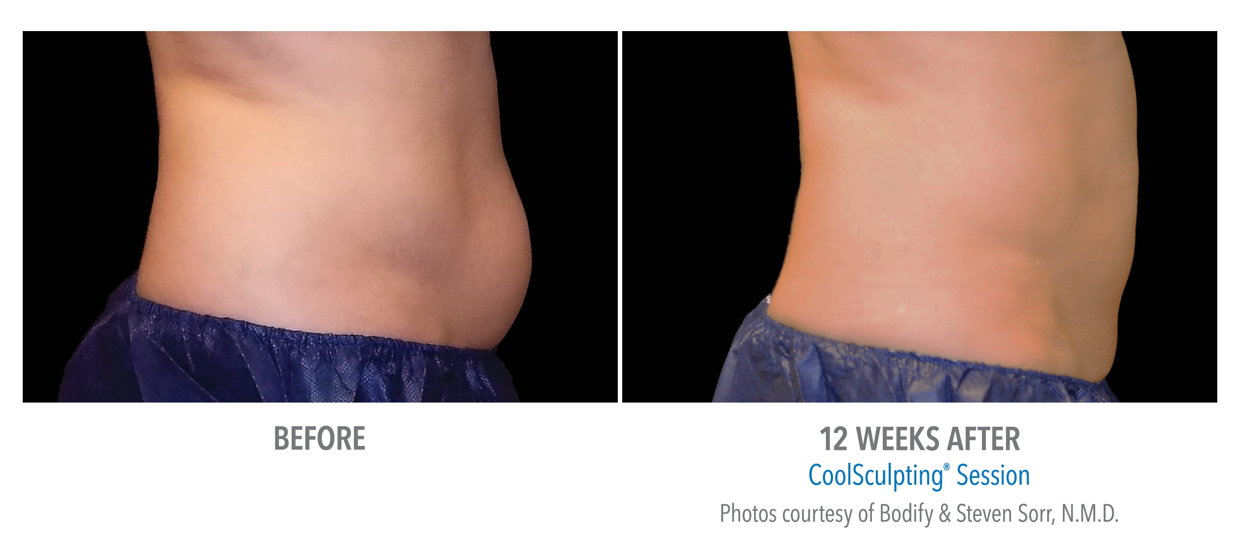 lower ab coolsculpting before after
