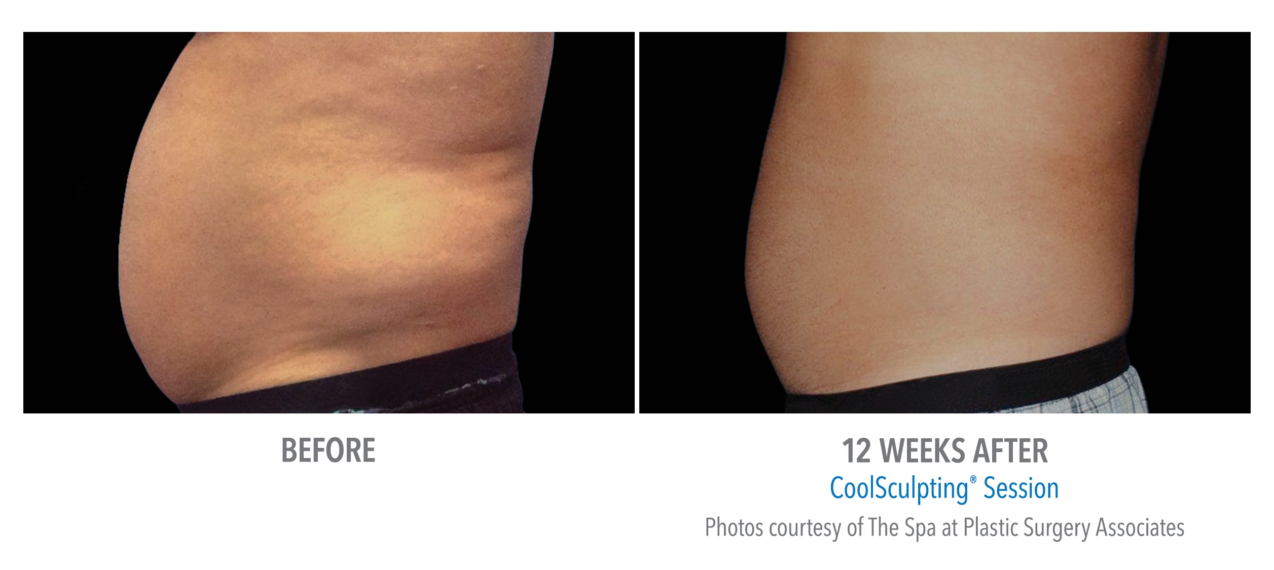 lower abdomen contouring before after
