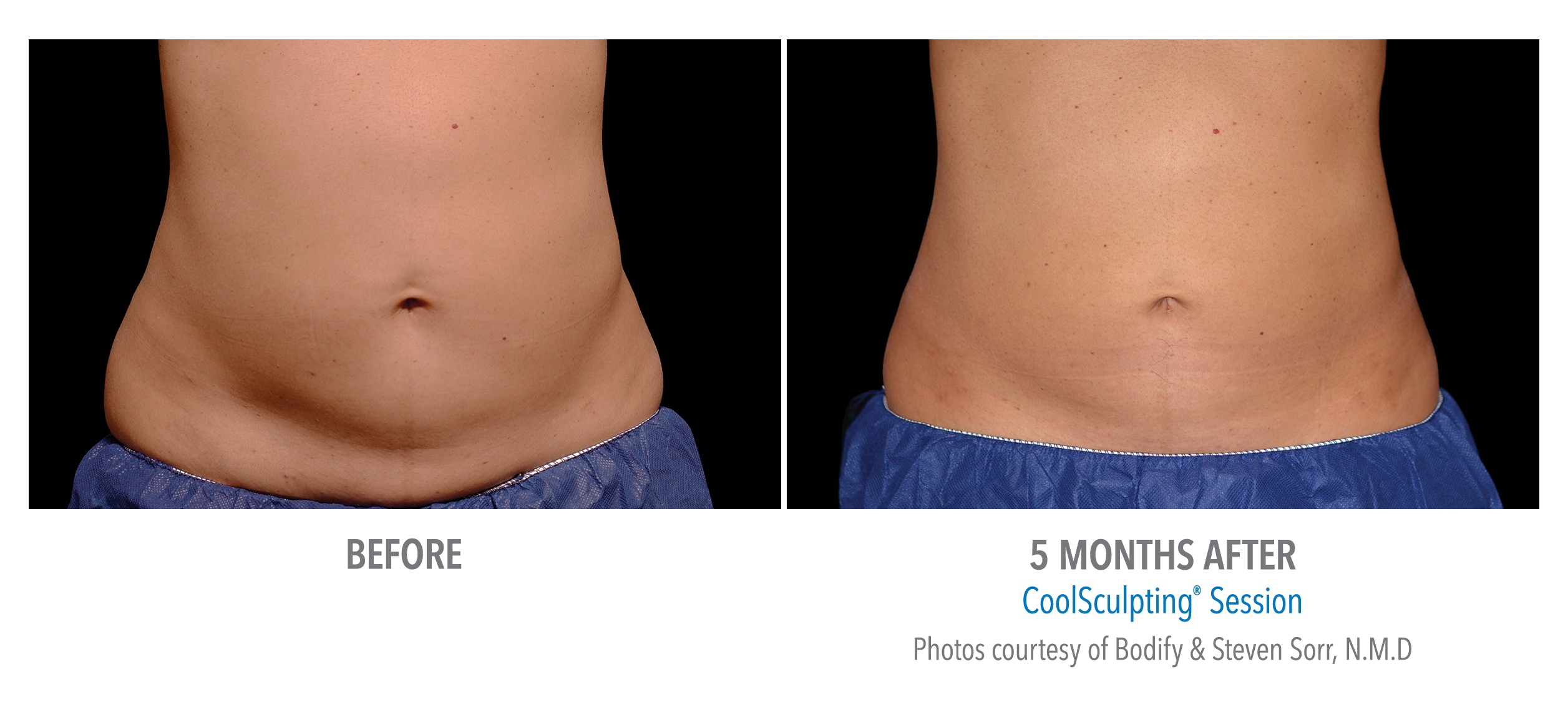 lower abdomen coolsculpting san diego