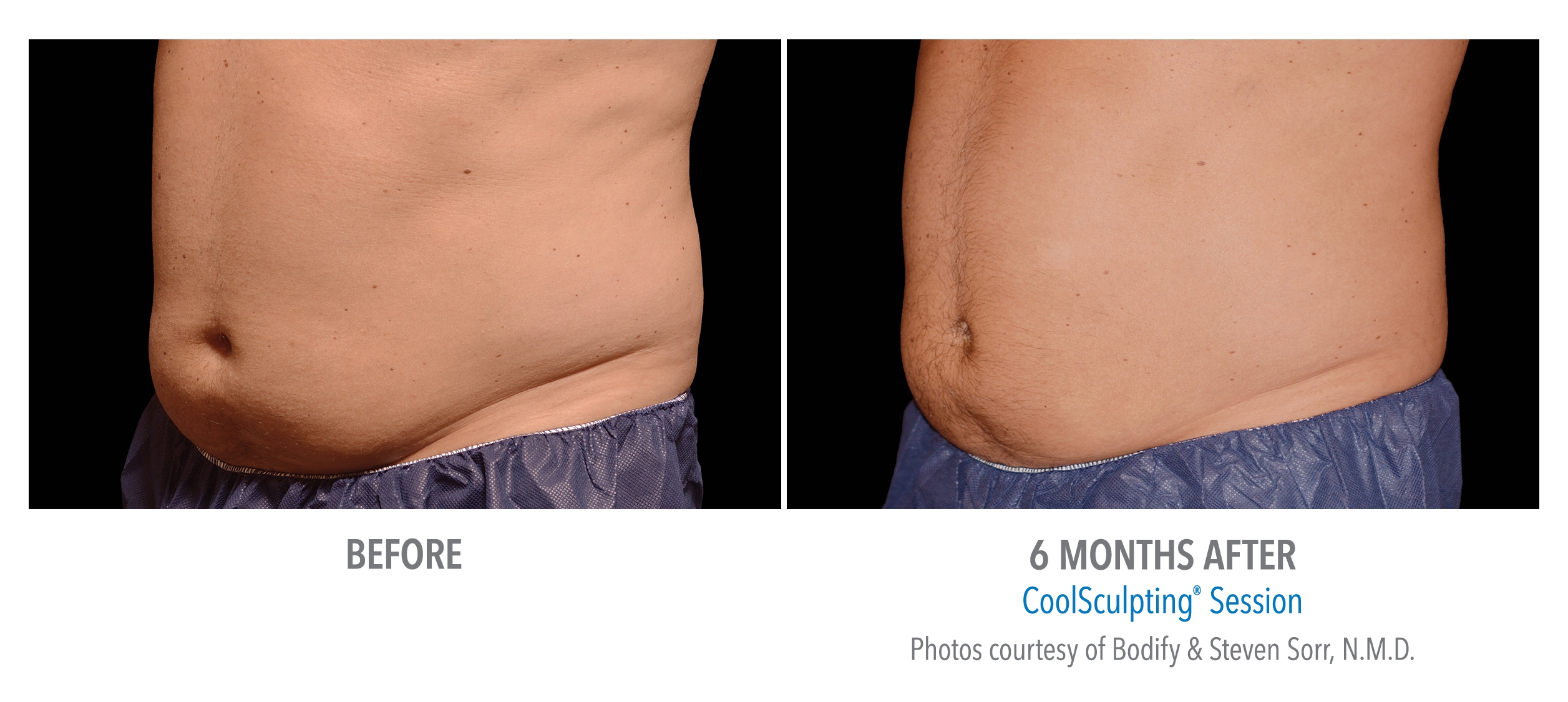 lower abdomen fat reduction