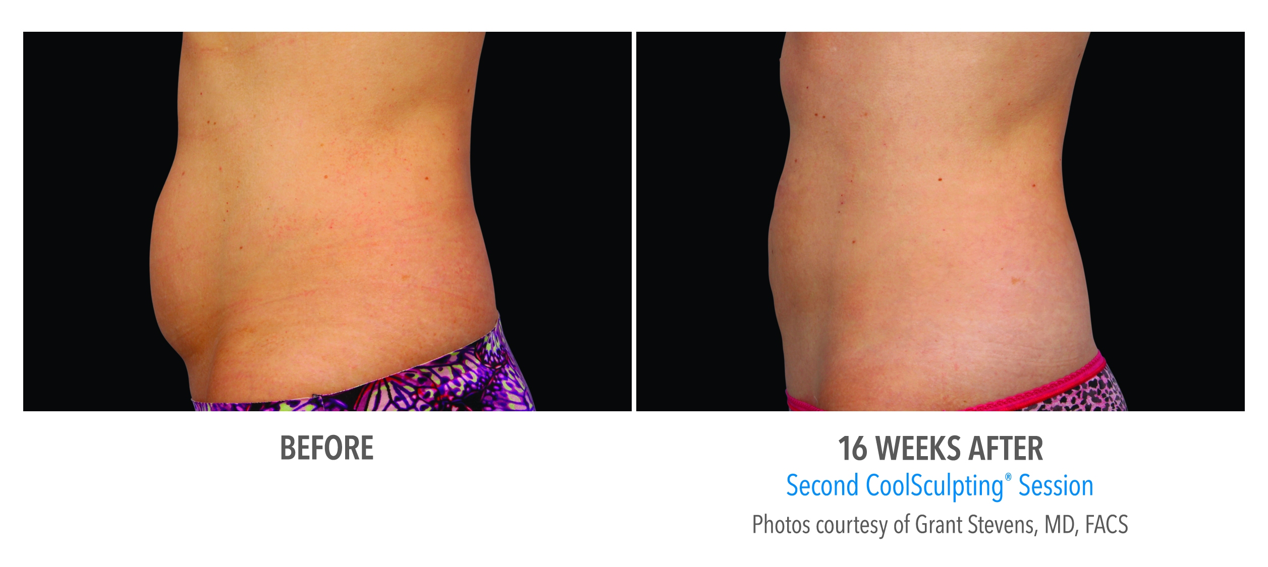 lower abdomen fat reduction before after