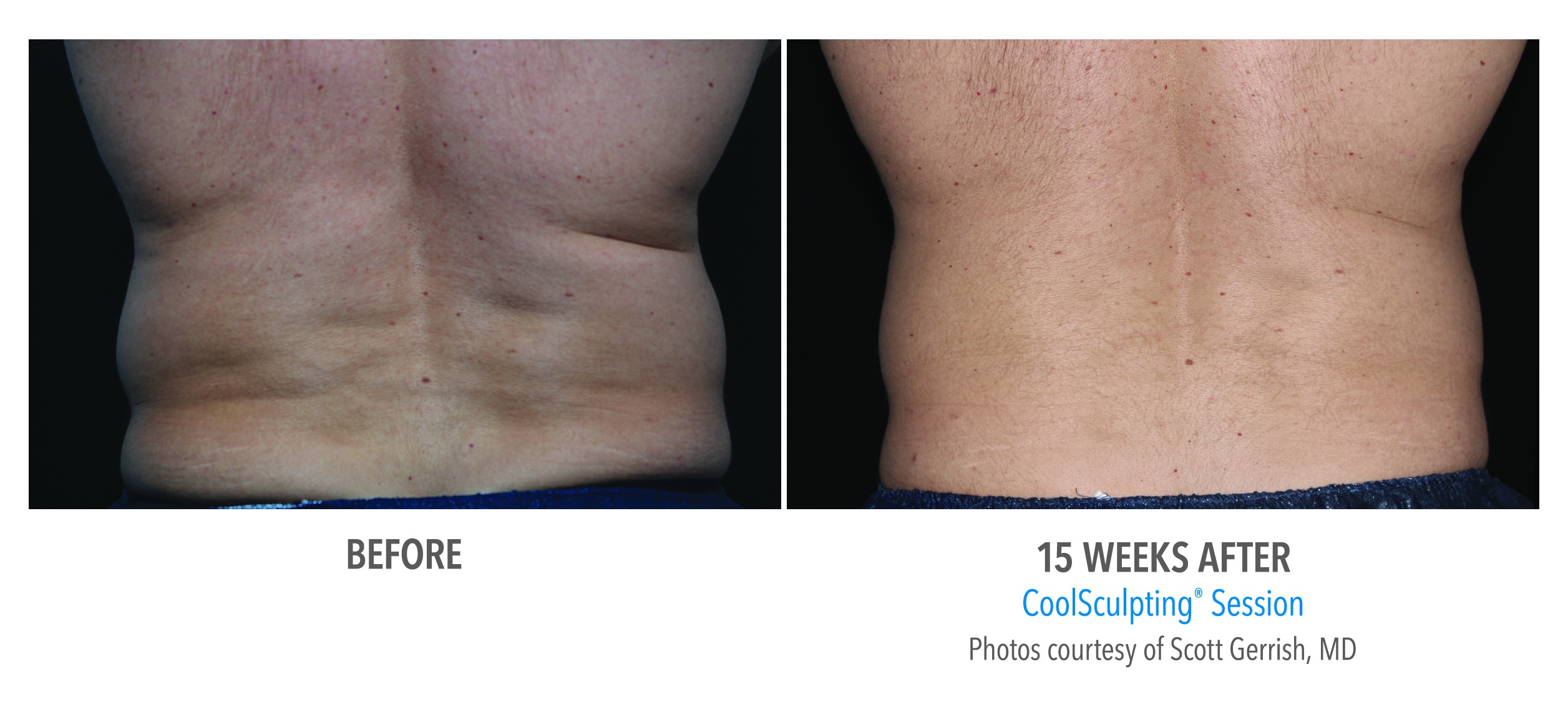 male flanks coolsculpting before after