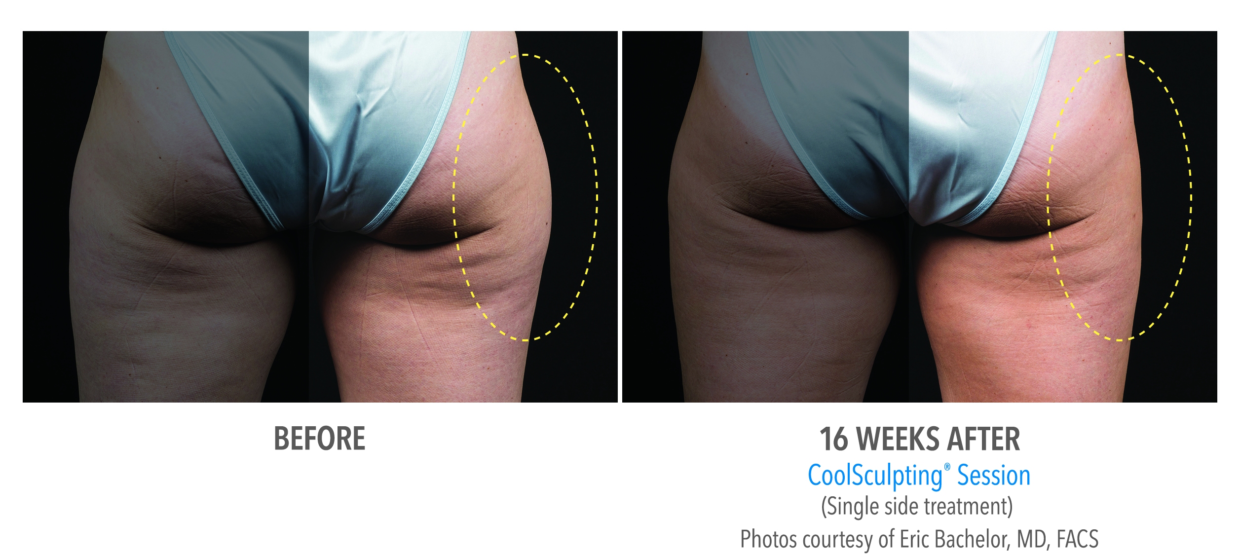 saddlebags coolsculpting before after