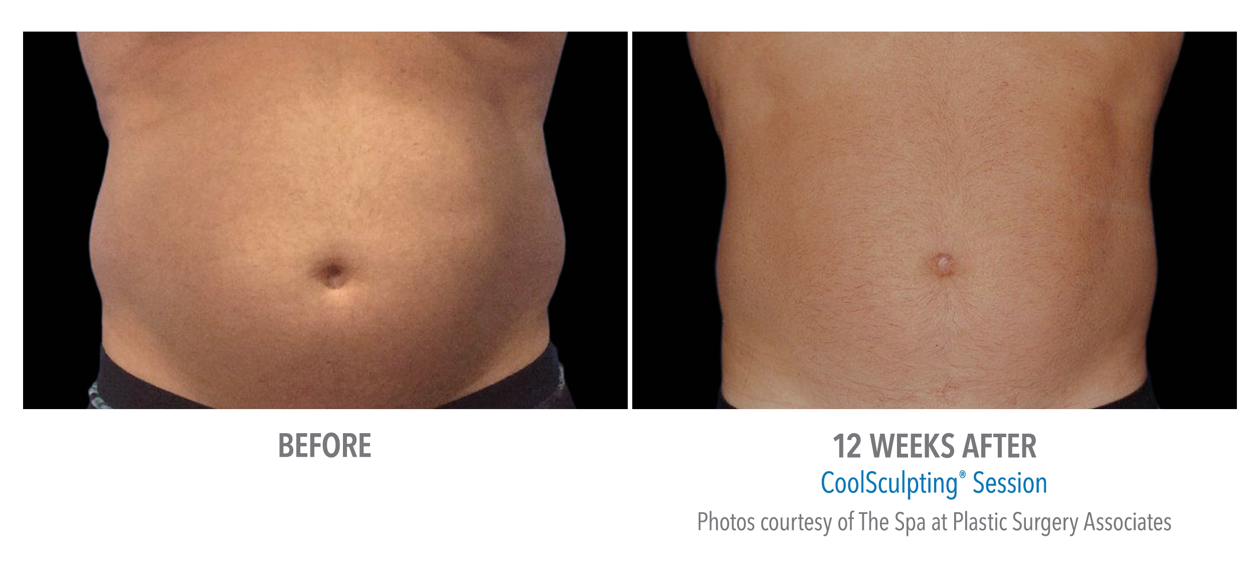 stomach coolsculpt