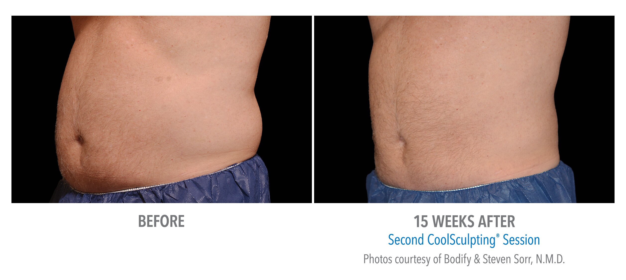 stomach coolsculpting before afters