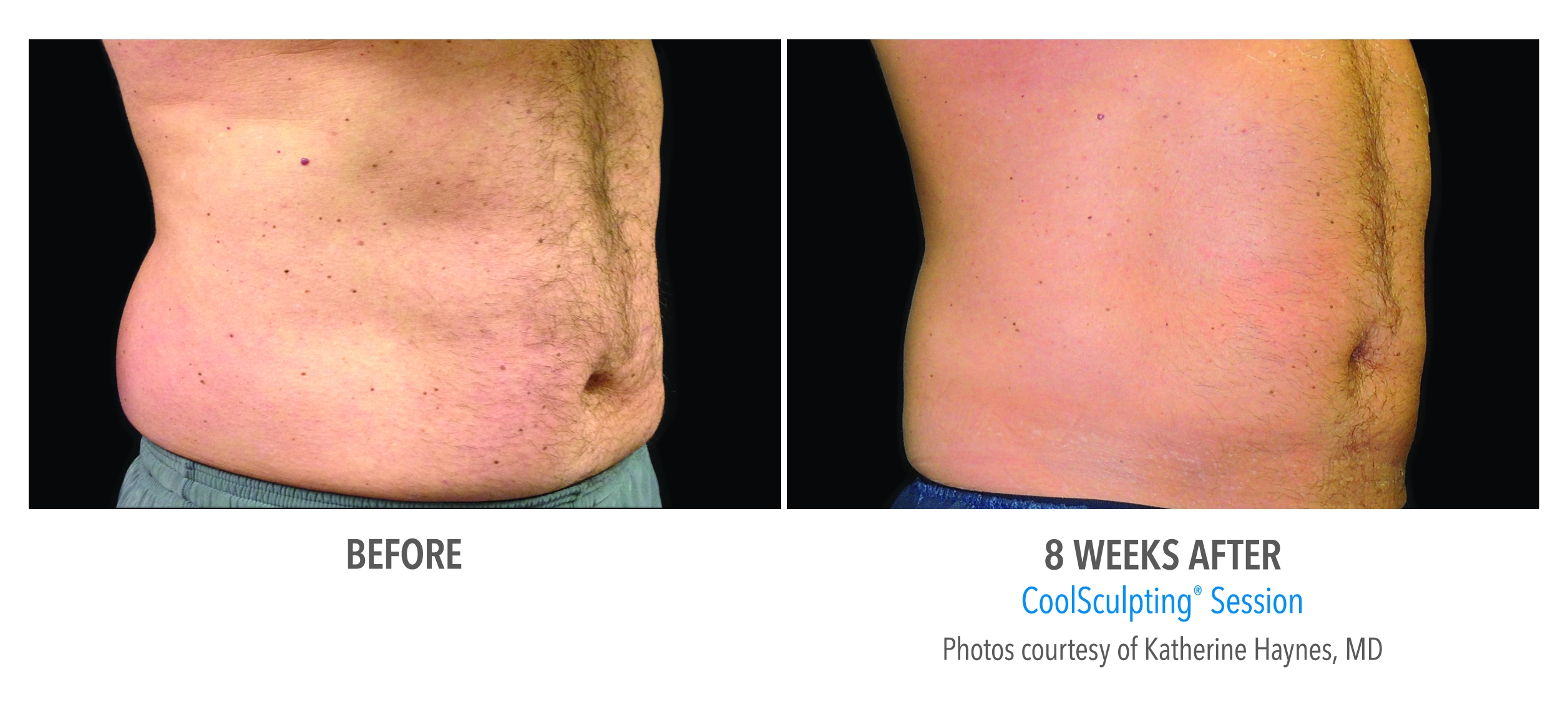 stomach fat reduction before after