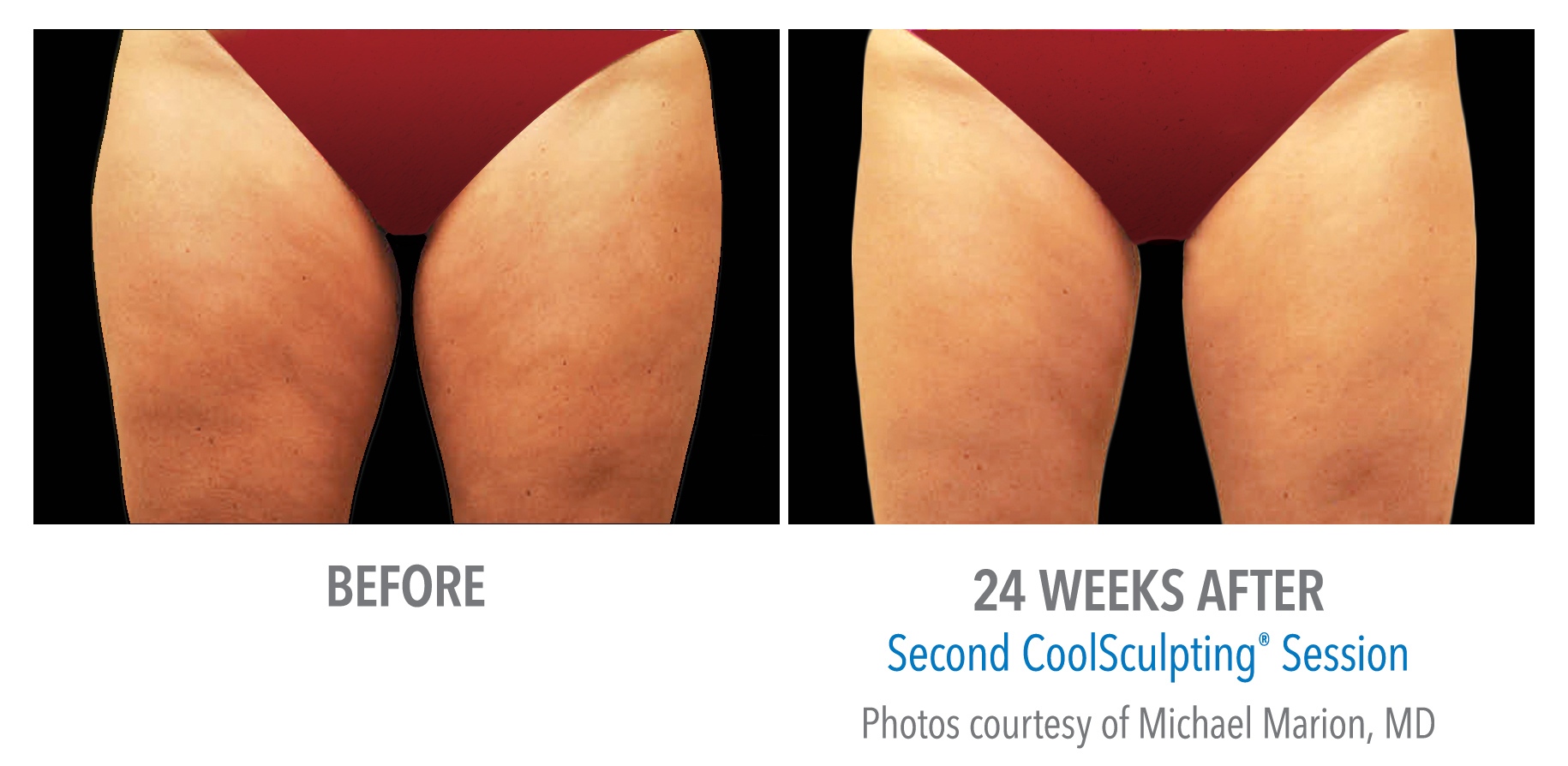thigh fat coolsculpting before after