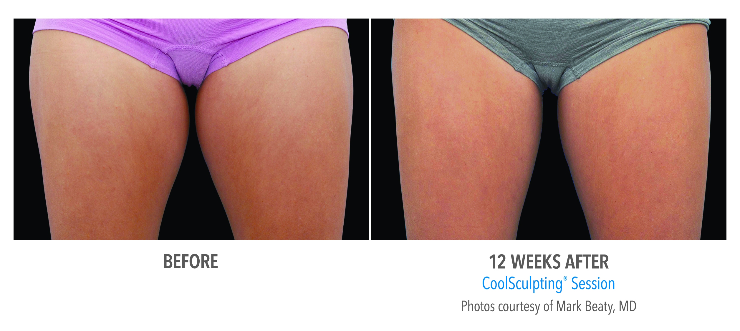 thigh reduction before after