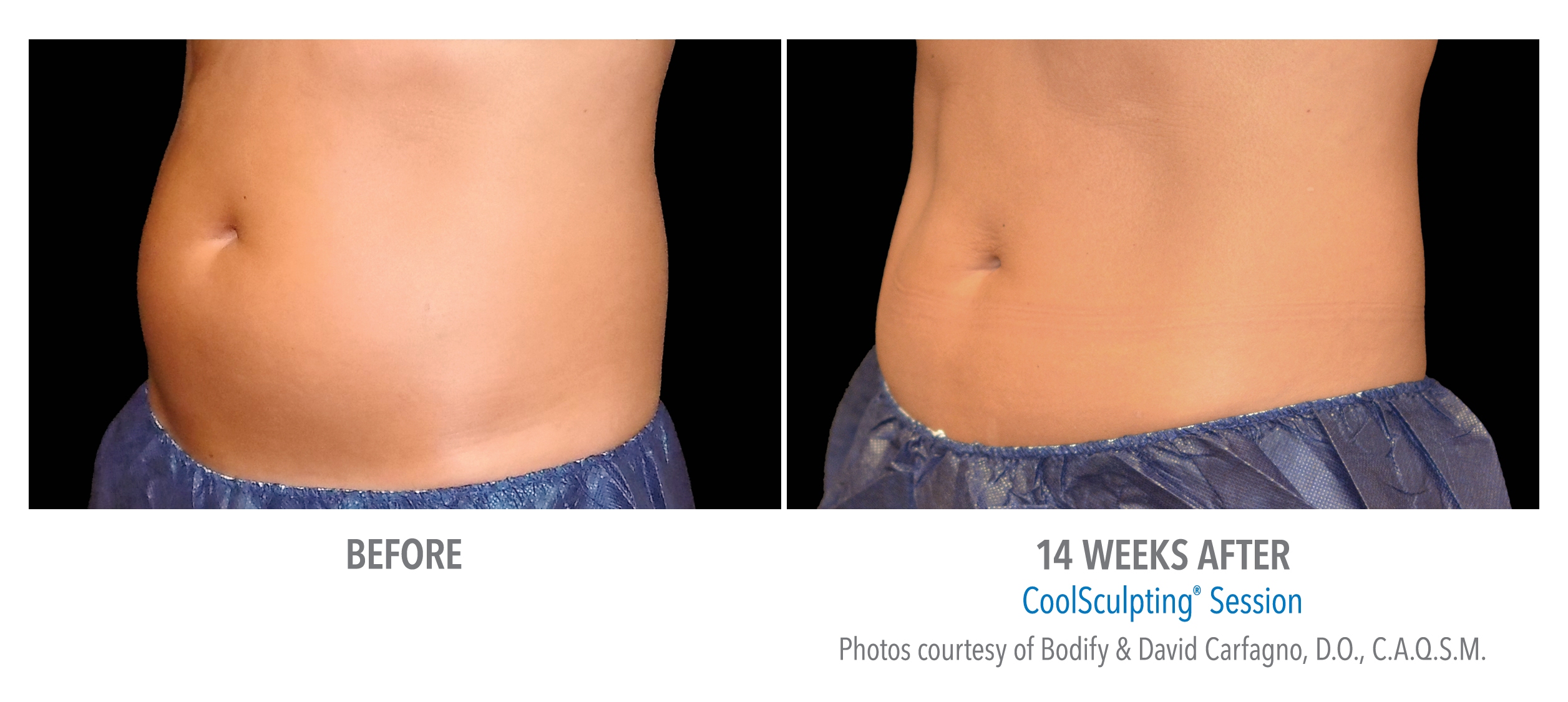 tummy coolsculpting before after